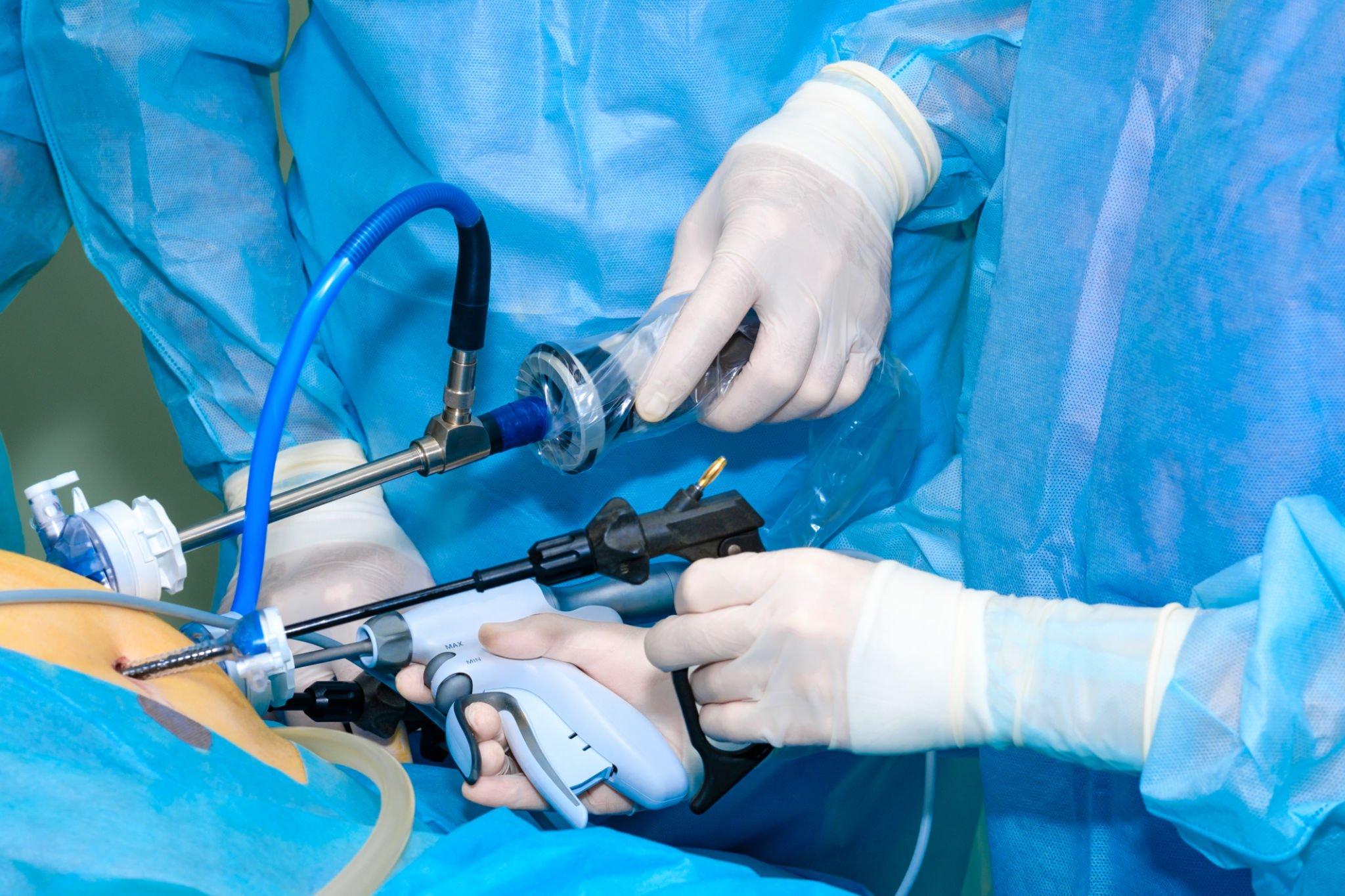 Learning Requirements for Doctors – Operative Technique for Laparoscopic Nissen Fundoplication